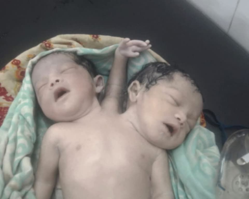 নওগাঁয় দুই মাথা ও তিন হাত বিশিষ্ট শিশুর জন্ম
