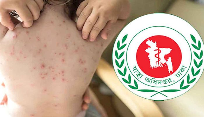 হাম ও উপসর্গে এক দিনে সর্বাধিক ১৭ শিশুর মৃত্যু
