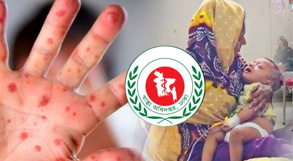হামের উপসর্গ নিয়ে ২৮ দিনে ১৬৯ শিশুর মৃত্যু