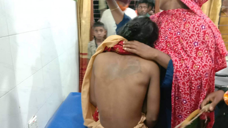 পারিবারিক কলহের জেরে গৃহবধূে এসিড দিলেন শ্বশুর-শ্বাশুড়ি