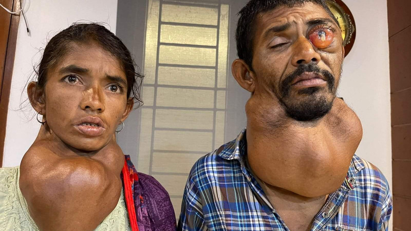 প্রধানমন্ত্রীর নির্দেশে টাঙ্গাইলের অসুস্থ দুই ভাই-বোনের চিকিৎসা শুরু