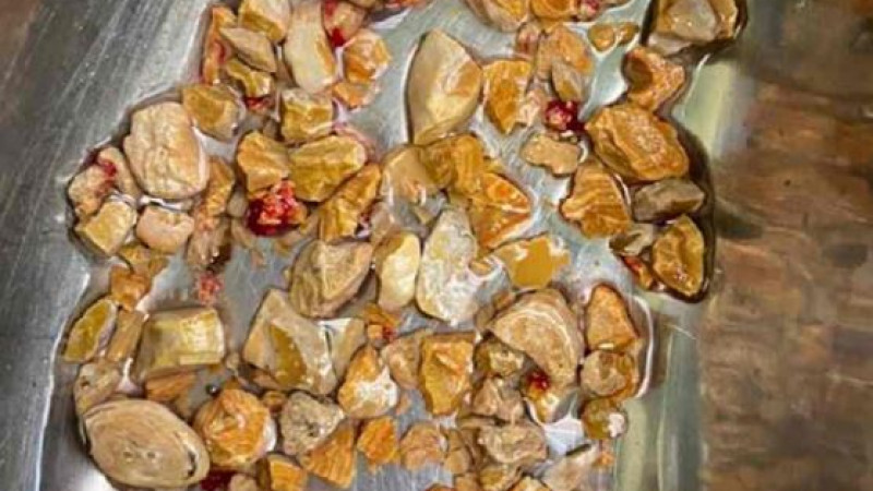কিডনিতে মিলল ২০৬টি পাথর